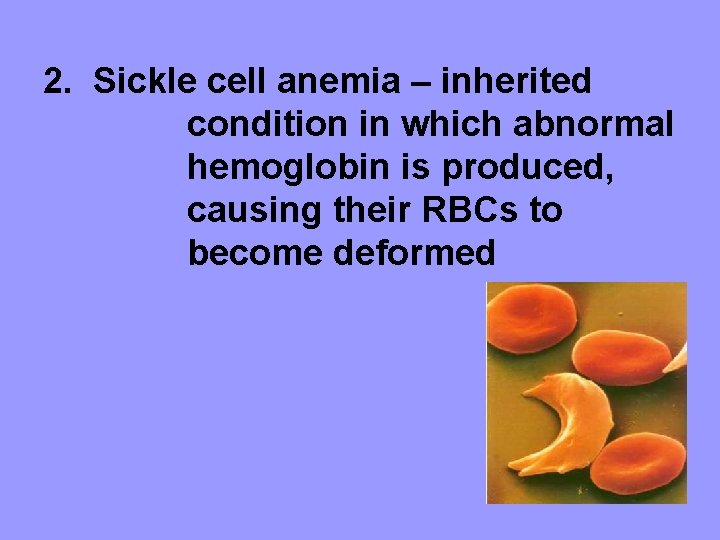 2. Sickle cell anemia – inherited condition in which abnormal hemoglobin is produced, causing