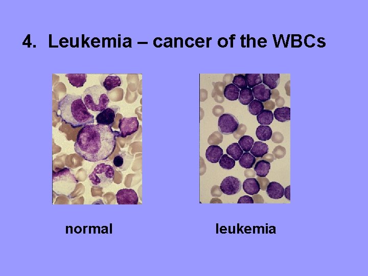 4. Leukemia – cancer of the WBCs normal leukemia 