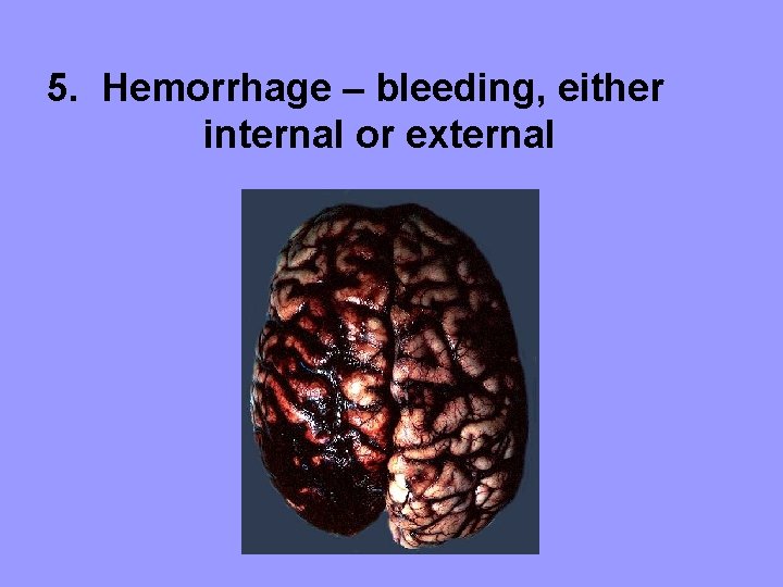 5. Hemorrhage – bleeding, either internal or external 