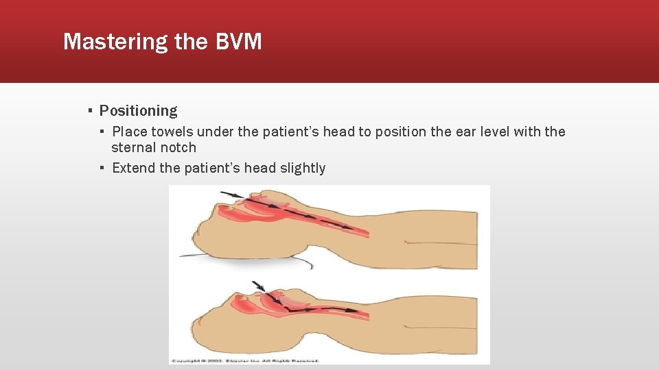 Mastering the BVM ▪ Positioning ▪ Place towels under the patient’s head to position
