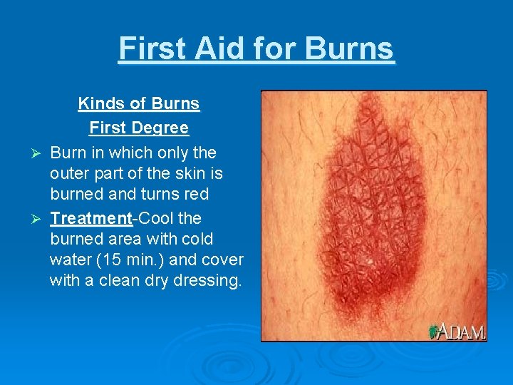 First Aid for Burns Kinds of Burns First Degree Ø Burn in which only