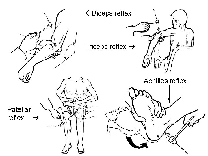  Biceps reflex Triceps reflex Achilles reflex Patellar reflex 