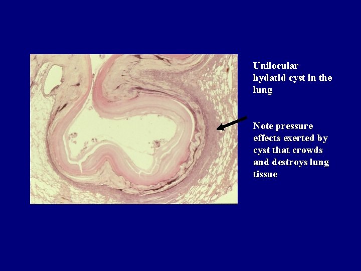 Unilocular hydatid cyst in the lung Note pressure effects exerted by cyst that crowds Unilocular hydatid cyst in the lung Note pressure effects exerted by cyst that crowds