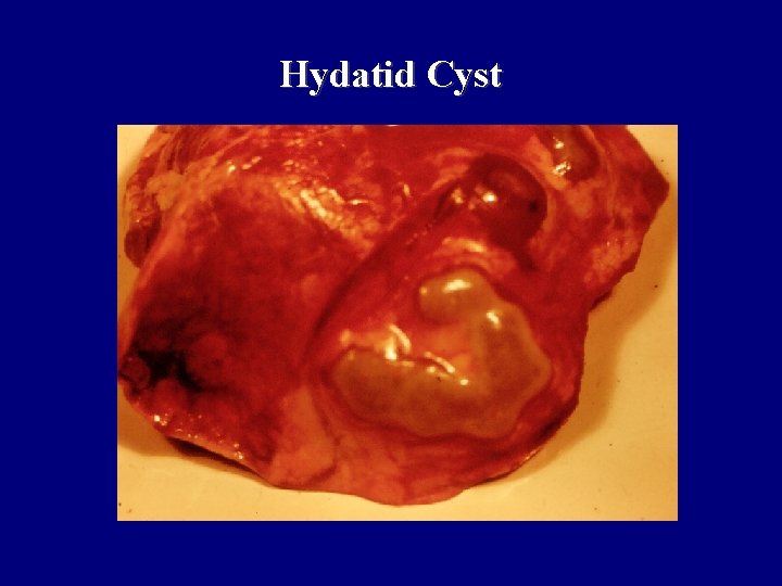 Hydatid Cyst Hydatid Cyst