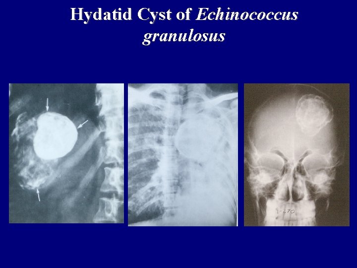 Hydatid Cyst of Echinococcus granulosus Hydatid Cyst of Echinococcus granulosus