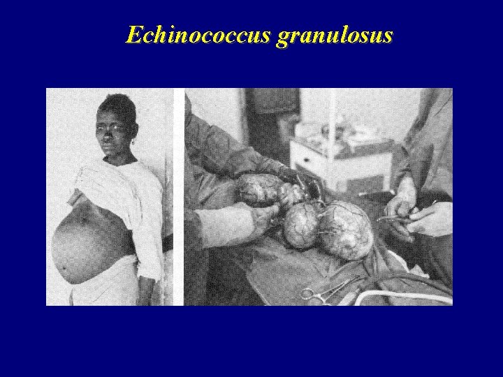 Echinococcus granulosus Echinococcus granulosus