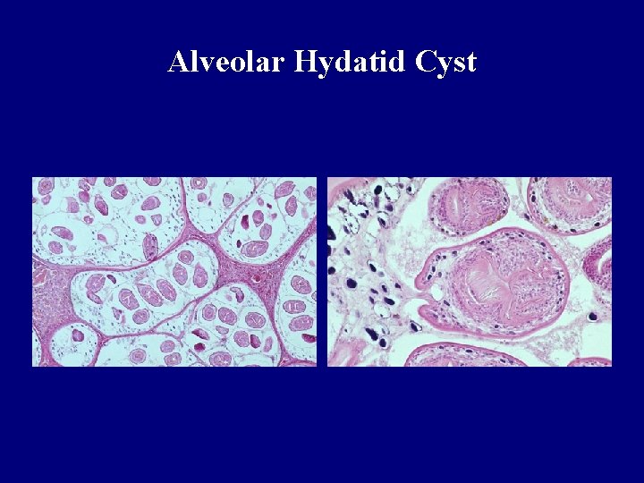 Alveolar Hydatid Cyst Alveolar Hydatid Cyst
