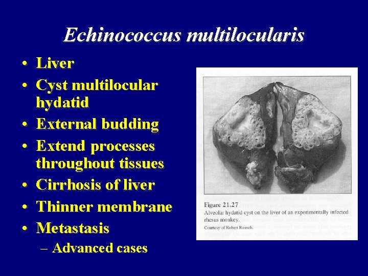 Echinococcus multilocularis • Liver • Cyst multilocular hydatid • External budding • Extend processes Echinococcus multilocularis • Liver • Cyst multilocular hydatid • External budding • Extend processes
