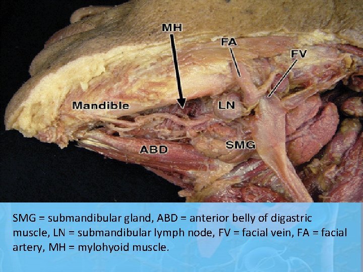 SMG = submandibular gland, ABD = anterior belly of digastric muscle, LN = submandibular