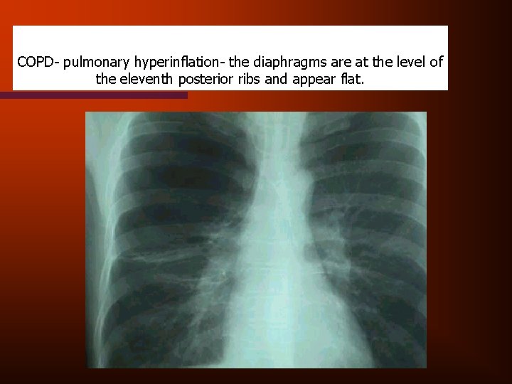 COPD- pulmonary hyperinflation- the diaphragms are at the level of the eleventh posterior ribs