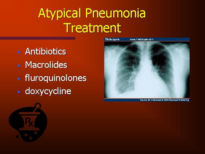 Atypical Pneumonia Treatment • • Antibiotics Macrolides fluroquinolones doxycycline 
