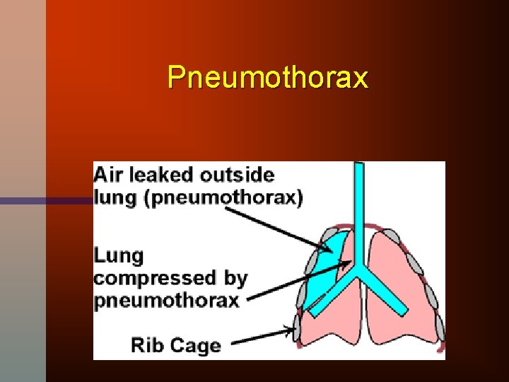 Pneumothorax 