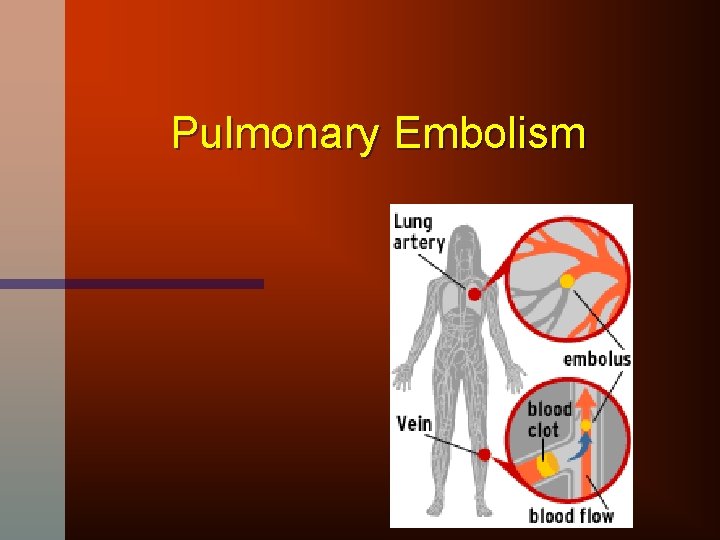 Pulmonary Embolism 