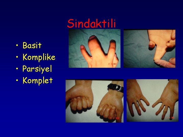 Sindaktili • • Basit Komplike Parsiyel Komplet 