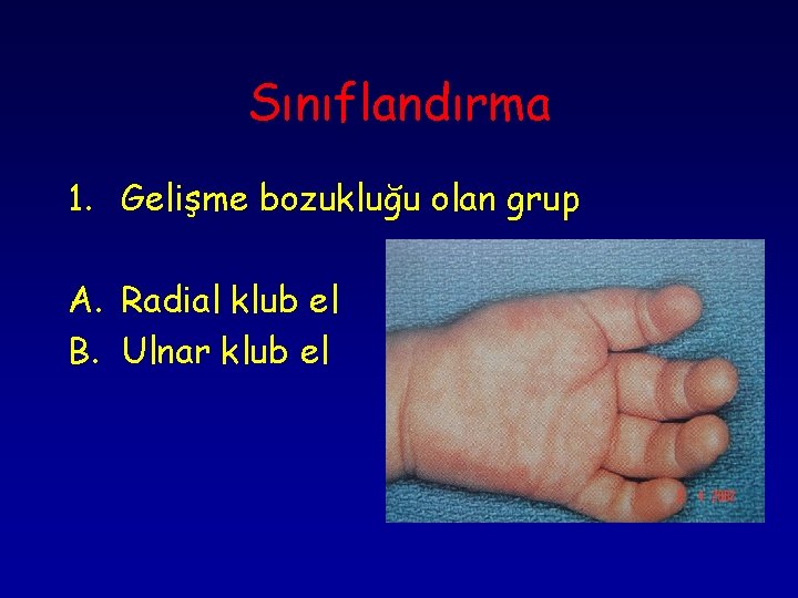 Sınıflandırma 1. Gelişme bozukluğu olan grup A. Radial klub el B. Ulnar klub el