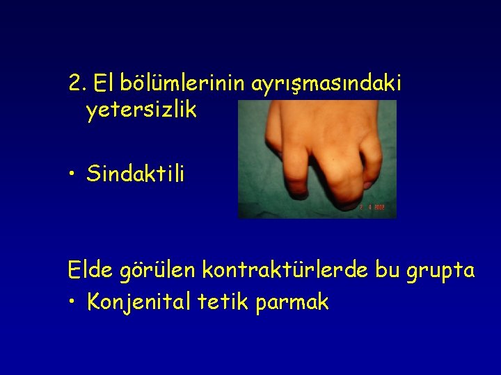 2. El bölümlerinin ayrışmasındaki yetersizlik • Sindaktili Elde görülen kontraktürlerde bu grupta • Konjenital