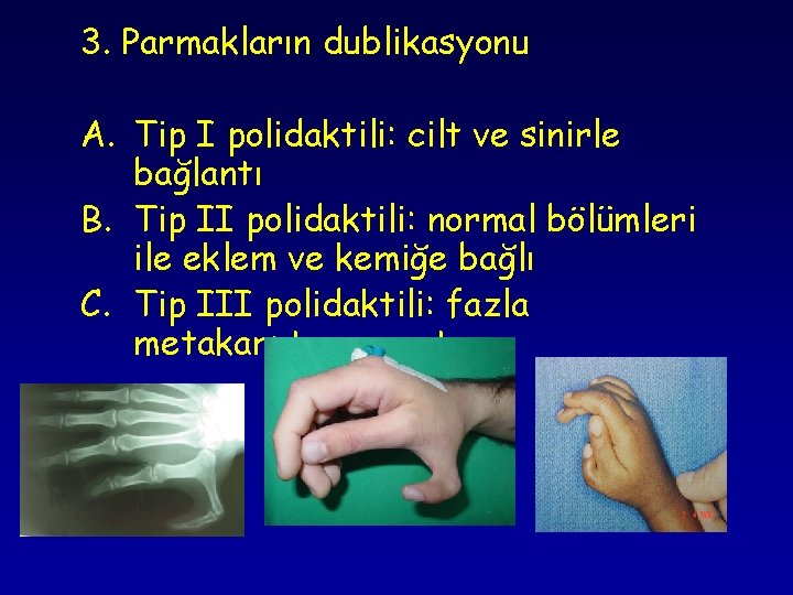 3. Parmakların dublikasyonu A. Tip I polidaktili: cilt ve sinirle bağlantı B. Tip II