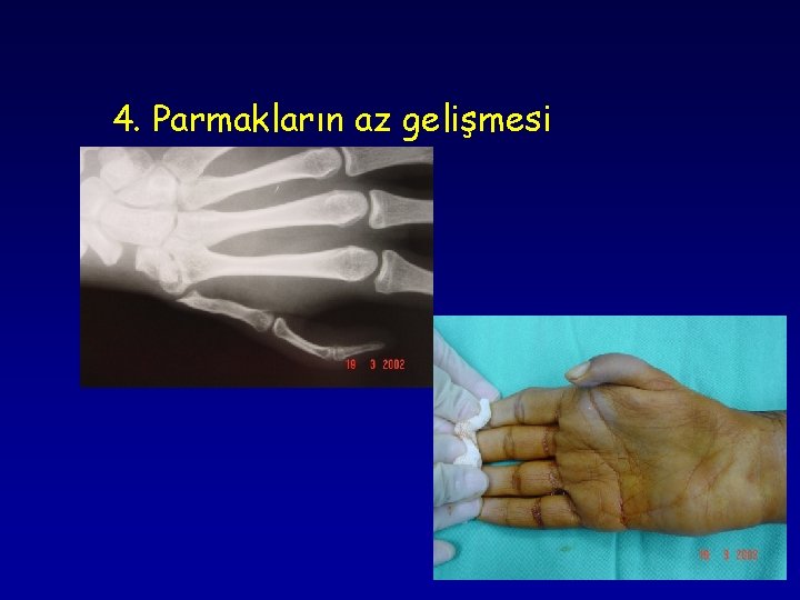 4. Parmakların az gelişmesi 