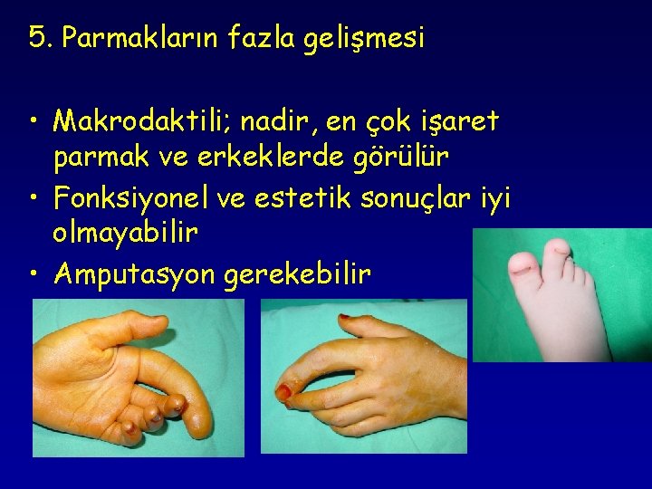 5. Parmakların fazla gelişmesi • Makrodaktili; nadir, en çok işaret parmak ve erkeklerde görülür