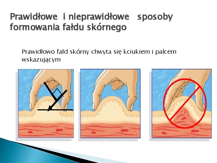 Prawidłowe i nieprawidłowe sposoby formowania fałdu skórnego Prawidłowo fałd skórny chwyta się kciukiem i