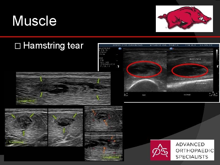 Muscle � Hamstring tear 