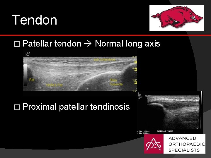 Tendon � Patellar tendon Normal long axis � Proximal patellar tendinosis 