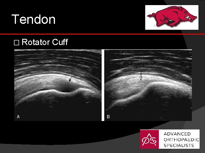 Tendon � Rotator Cuff 