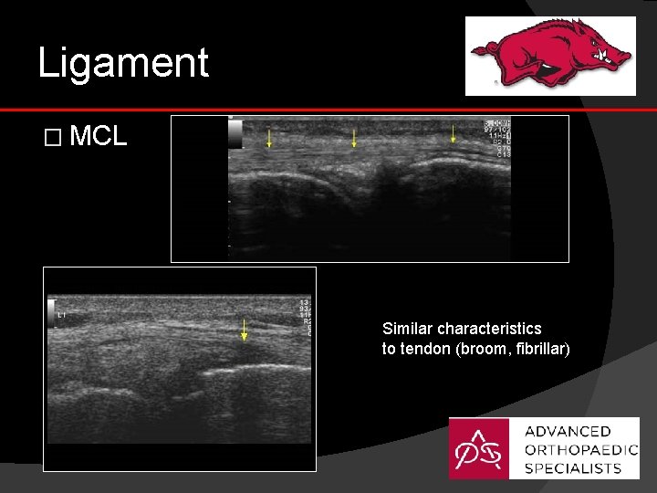 Ligament � MCL Similar characteristics to tendon (broom, fibrillar) 