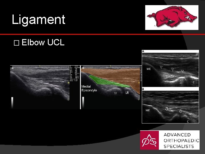 Ligament � Elbow UCL 