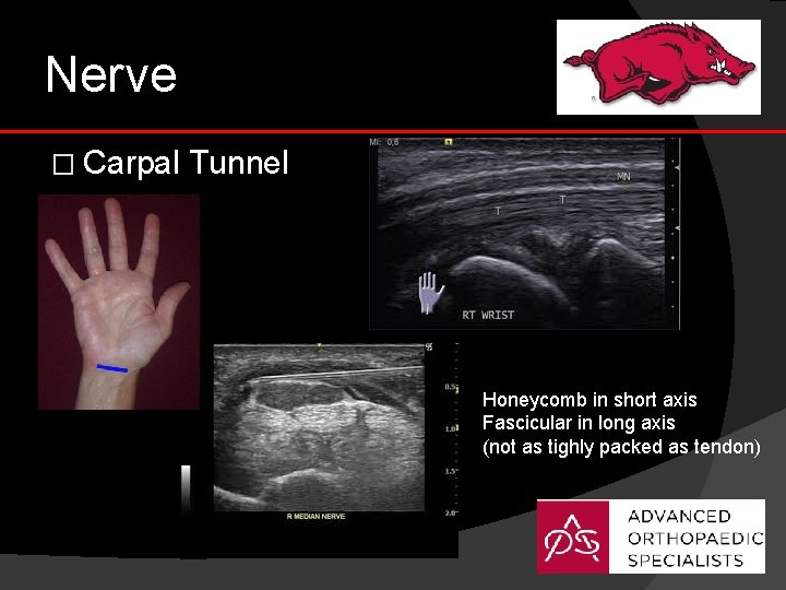 Nerve � Carpal Tunnel Honeycomb in short axis Fascicular in long axis (not as