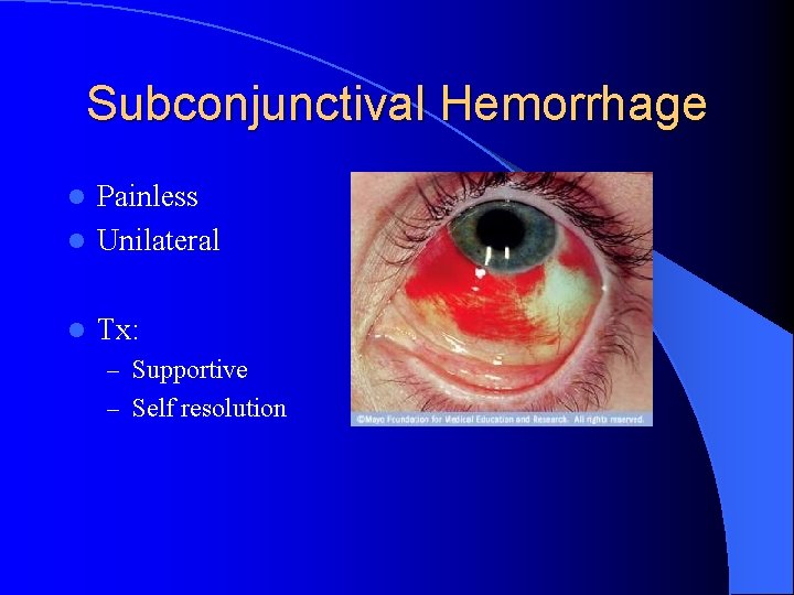 Subconjunctival Hemorrhage Painless l Unilateral l l Tx: – Supportive – Self resolution 