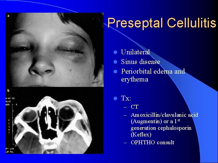 Preseptal Cellulitis Unilateral l Sinus disease l Periorbital edema and erythema l l Tx: