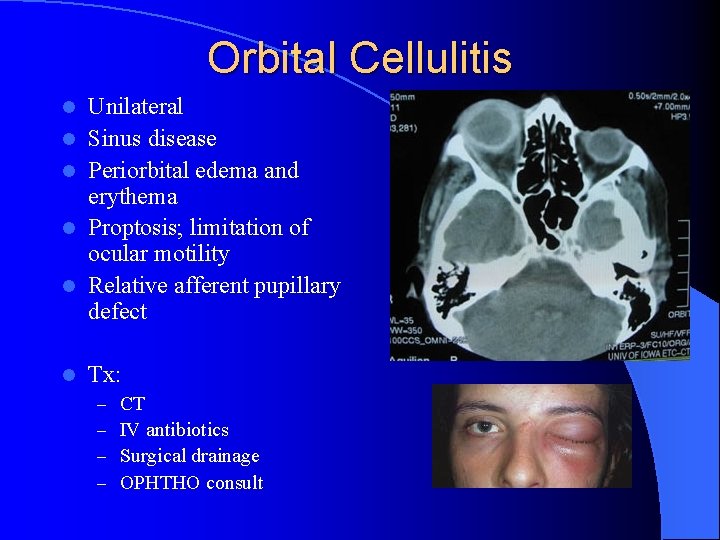 Orbital Cellulitis l l l Unilateral Sinus disease Periorbital edema and erythema Proptosis; limitation