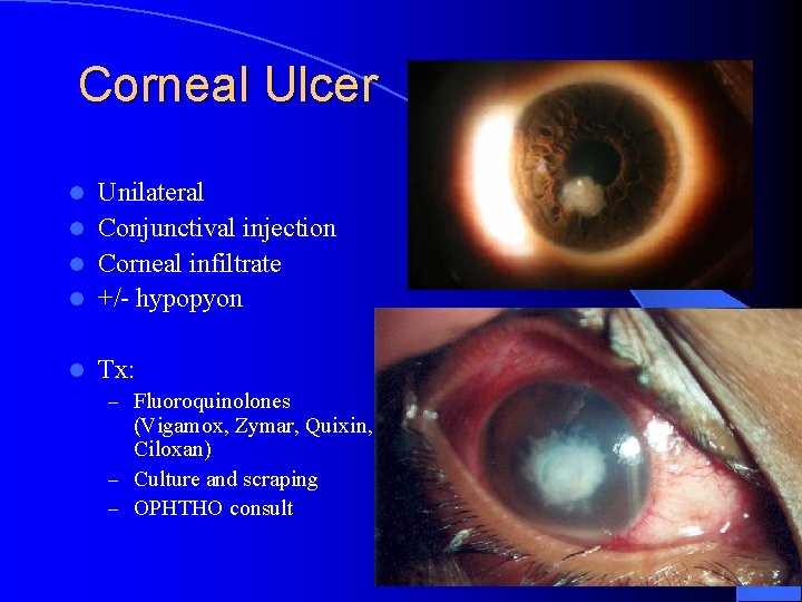 Corneal Ulcer Unilateral l Conjunctival injection l Corneal infiltrate l +/- hypopyon l l