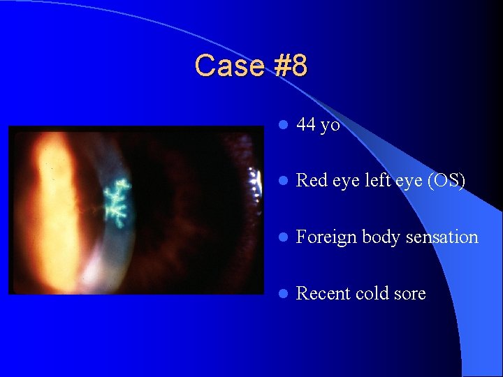 Case #8 l 44 yo l Red eye left eye (OS) l Foreign body