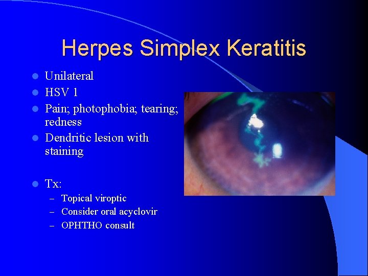 Herpes Simplex Keratitis Unilateral l HSV 1 l Pain; photophobia; tearing; redness l Dendritic