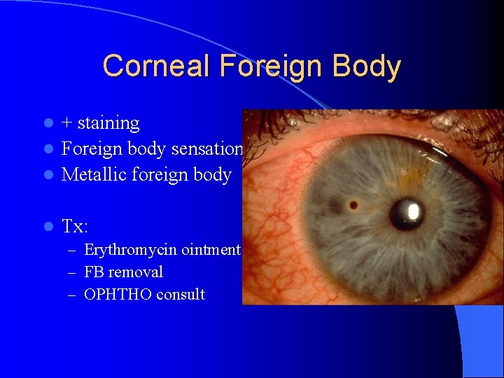 Corneal Foreign Body + staining l Foreign body sensation l Metallic foreign body l