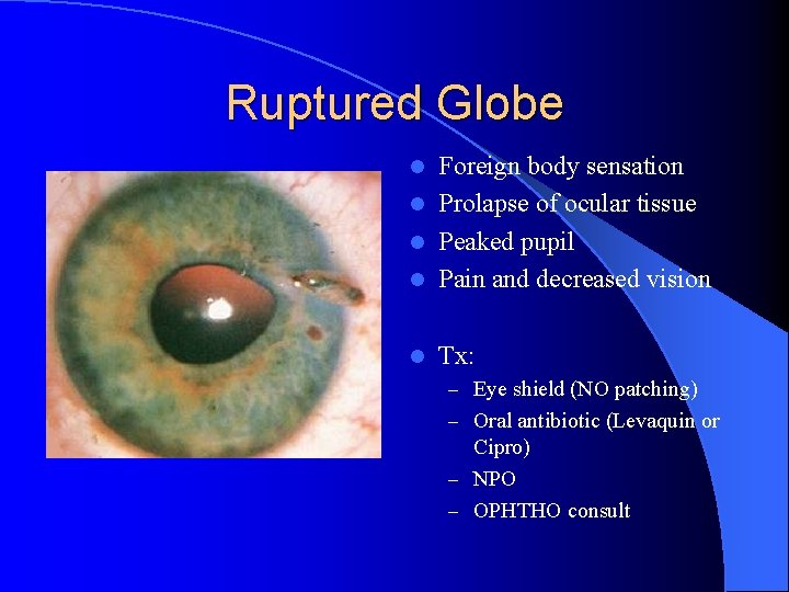 Ruptured Globe Foreign body sensation l Prolapse of ocular tissue l Peaked pupil l