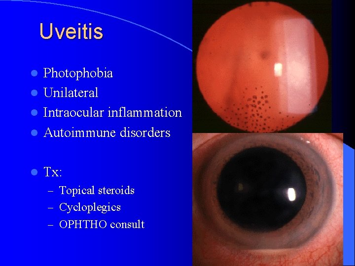 Uveitis Photophobia l Unilateral l Intraocular inflammation l Autoimmune disorders l l Tx: –