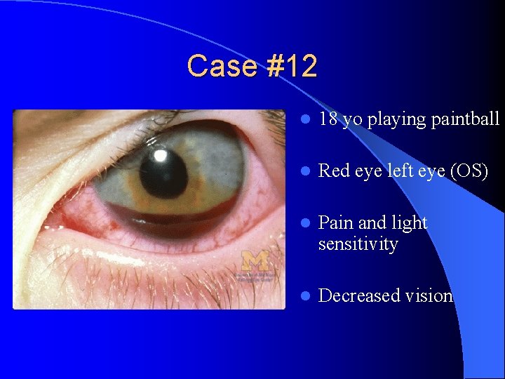 Case #12 l 18 yo playing paintball l Red eye left eye (OS) l