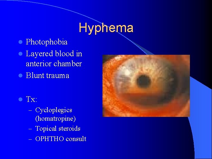 Hyphema Photophobia l Layered blood in anterior chamber l Blunt trauma l l Tx: