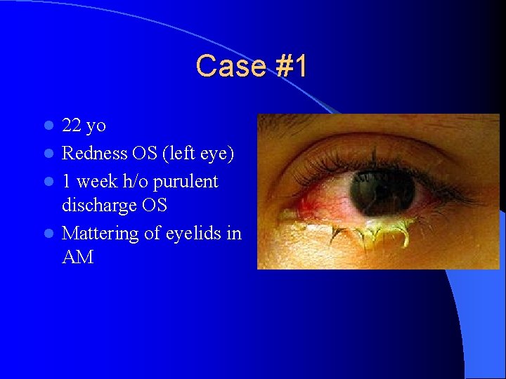 Case #1 22 yo l Redness OS (left eye) l 1 week h/o purulent