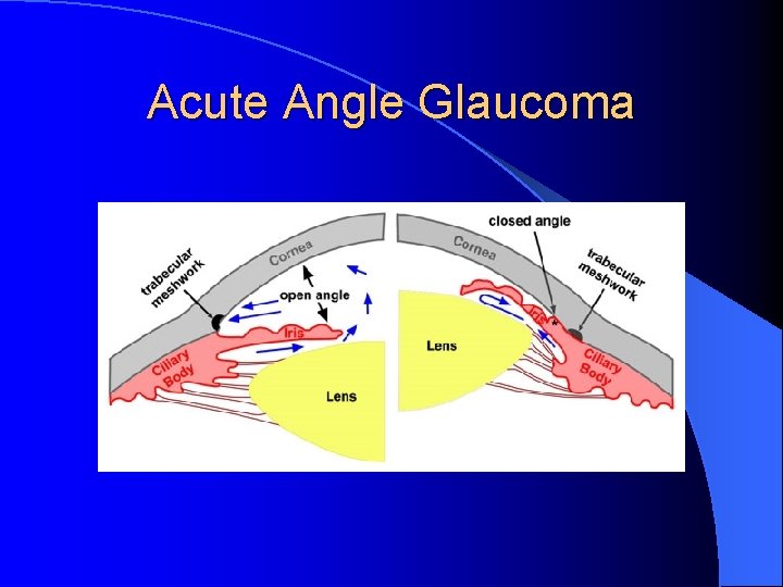 Acute Angle Glaucoma 