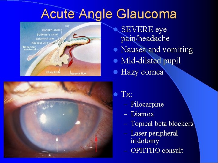 Acute Angle Glaucoma SEVERE eye pain/headache l Nausea and vomiting l Mid-dilated pupil l