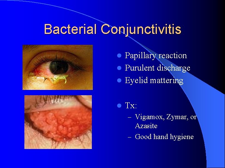 Bacterial Conjunctivitis Papillary reaction l Purulent discharge l Eyelid mattering l l Tx: –