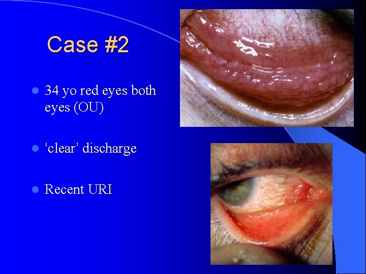 Case #2 l 34 yo red eyes both eyes (OU) l ‘clear’ discharge l