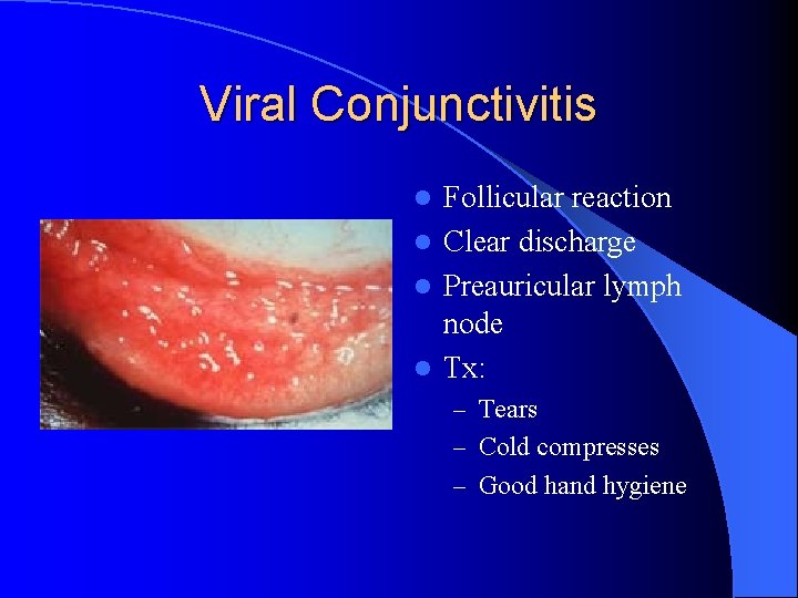 Viral Conjunctivitis Follicular reaction l Clear discharge l Preauricular lymph node l Tx: l