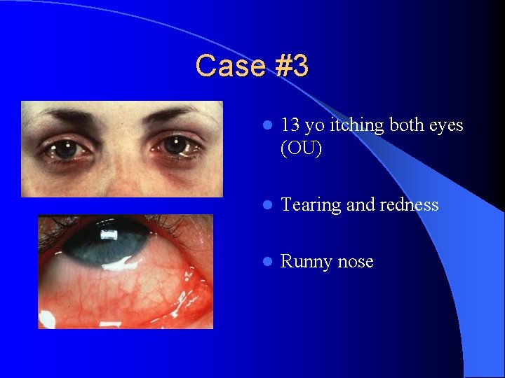 Case #3 l 13 yo itching both eyes (OU) l Tearing and redness l