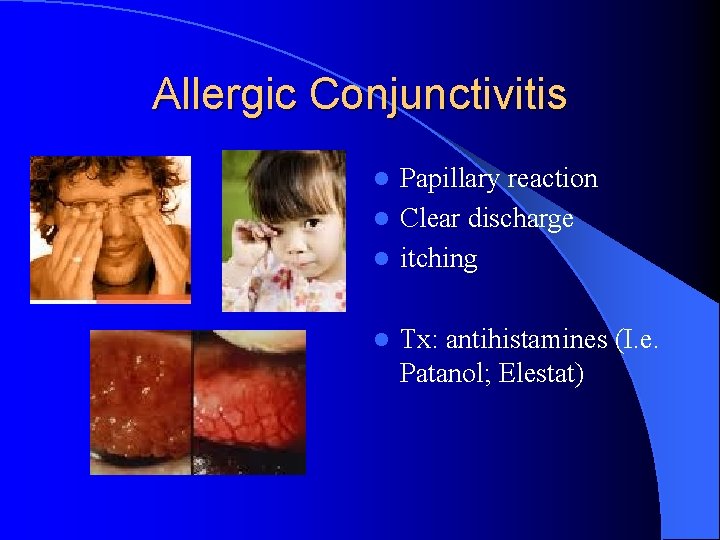 Allergic Conjunctivitis Papillary reaction l Clear discharge l itching l l Tx: antihistamines (I.