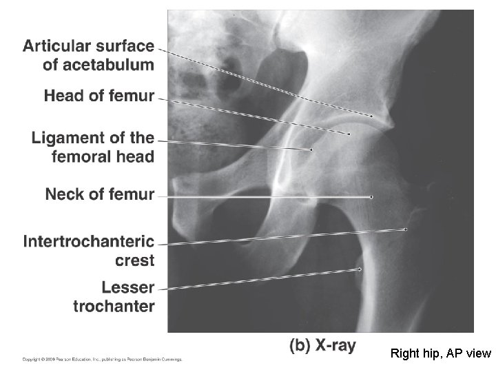 Right hip, AP view 